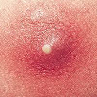 A cyst is a small fluid-filled lump that can form in or on a persons body. . Boil under breast pictures
